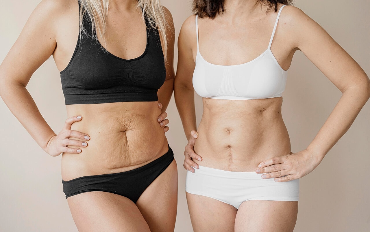 What Is The Difference Between a Tummy Tuck And Liposuction​?