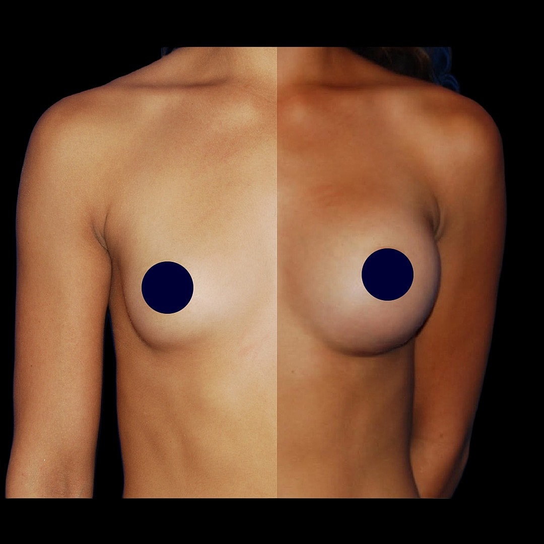 Before and after cosmetic breast enhancement comparison.