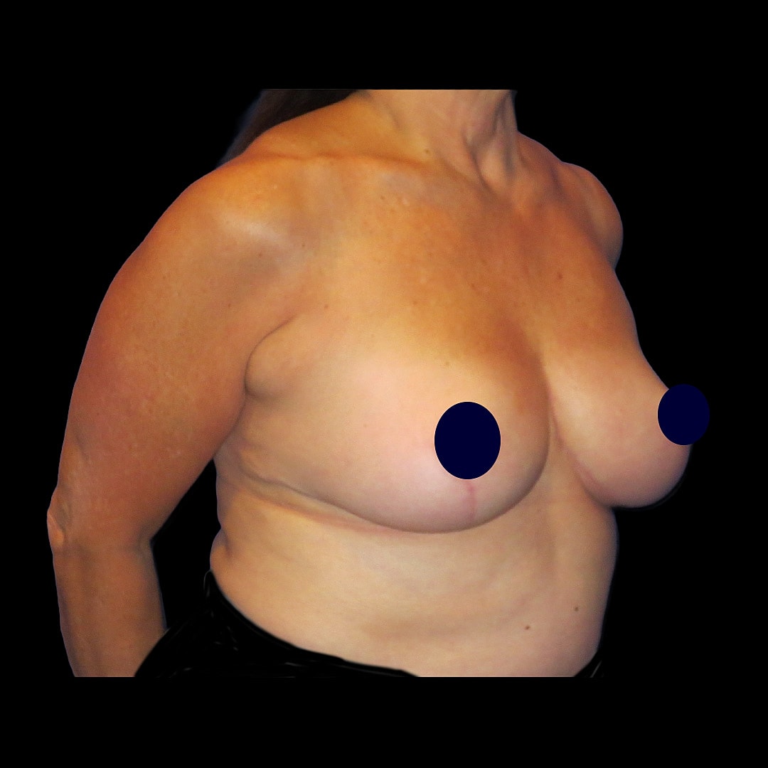 Breast anatomy with censoring for privacy.