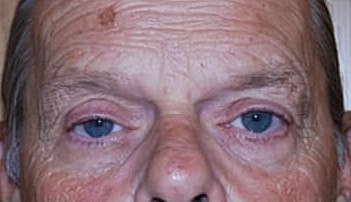 Blepharoplasty Before & After