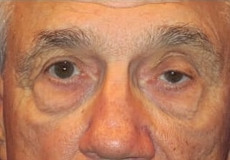 Blepharoplasty Before & After