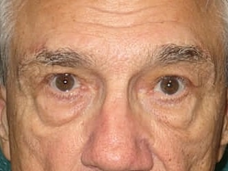 Blepharoplasty Before & After