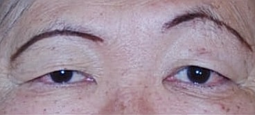 Blepharoplasty Before & After