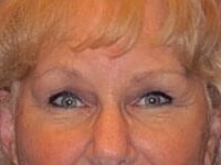 Blepharoplasty Before & After