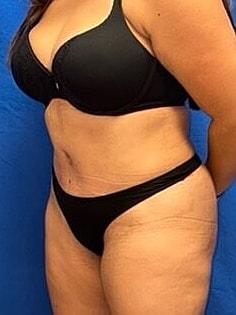 Tummy Tuck Before & After