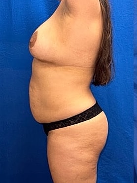 Tummy Tuck Before & After