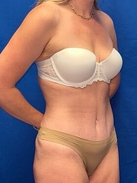 Tummy Tuck Before & After
