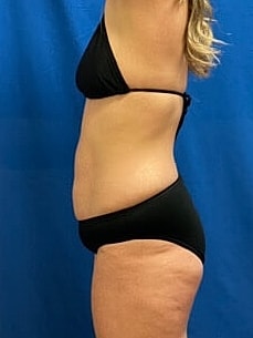 Tummy Tuck Before & After