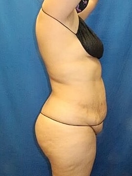 Tummy Tuck Before & After