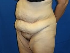 Tummy Tuck Before & After