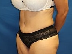 Tummy Tuck Before & After