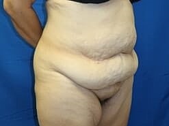 Tummy Tuck Before & After