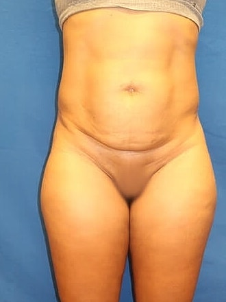 Tummy Tuck Before & After