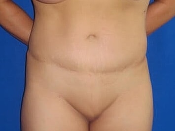Tummy Tuck Before & After