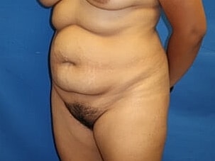 Tummy Tuck Before & After