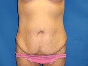 Tummy Tuck Before & After