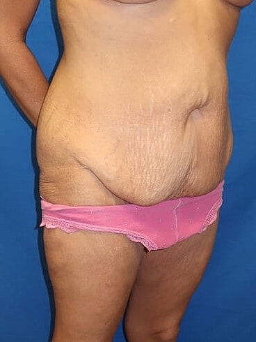 Tummy Tuck Before & After