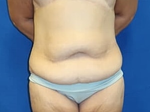 Tummy Tuck Before & After