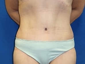 Tummy Tuck Before & After