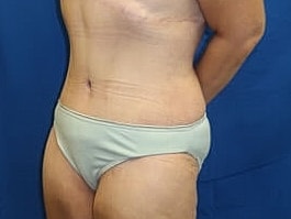 Tummy Tuck Before & After