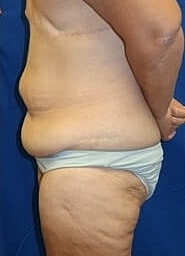 Tummy Tuck Before & After