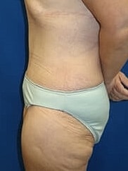 Tummy Tuck Before & After