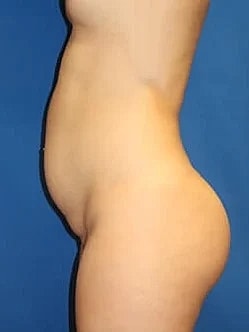 Tummy Tuck Before & After