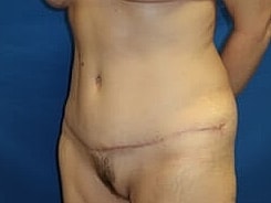 Tummy Tuck Before & After