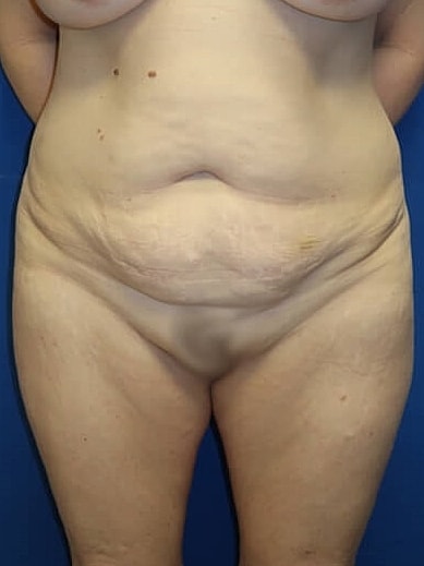 Tummy Tuck Before & After