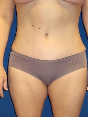 Tummy Tuck Before & After