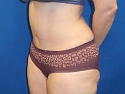Tummy Tuck Before & After