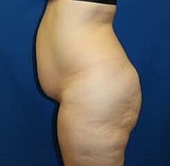 Tummy Tuck Before & After