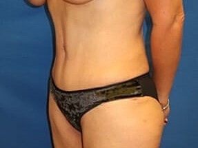 Tummy Tuck Before & After