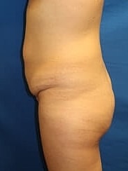 Tummy Tuck Before & After