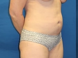 Tummy Tuck Before & After