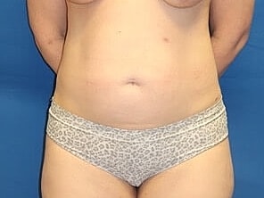 Tummy Tuck Before & After