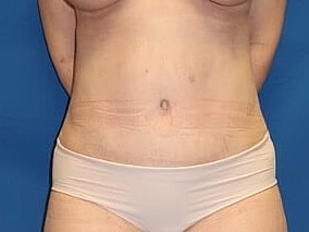 Tummy Tuck Before & After