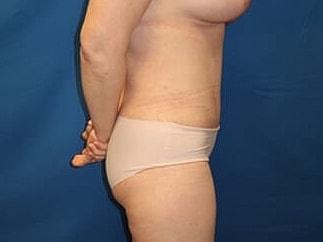 Tummy Tuck Before & After