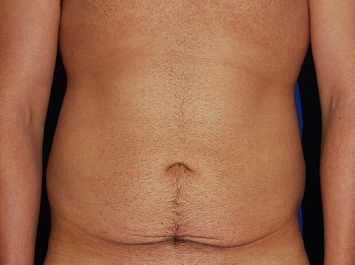 Tummy Tuck Before & After