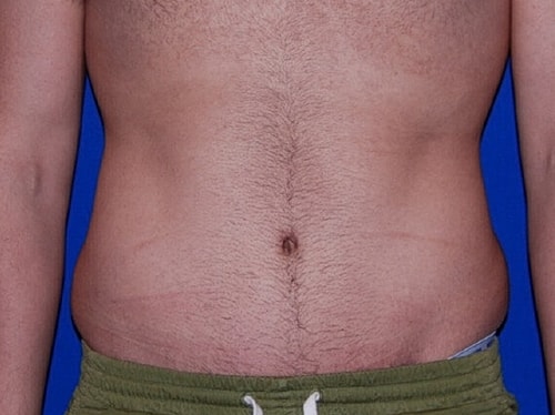 Tummy Tuck Before & After