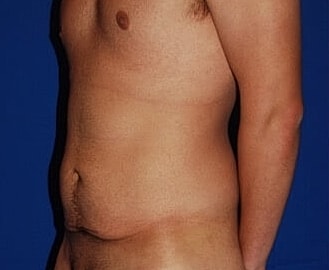 Tummy Tuck Before & After