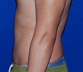 Tummy Tuck Before & After