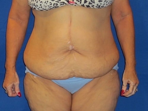 Tummy Tuck Before & After
