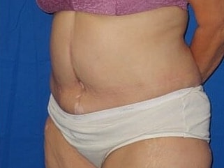 Tummy Tuck Before & After