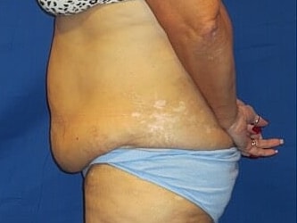 Tummy Tuck Before & After