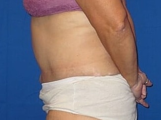 Tummy Tuck Before & After