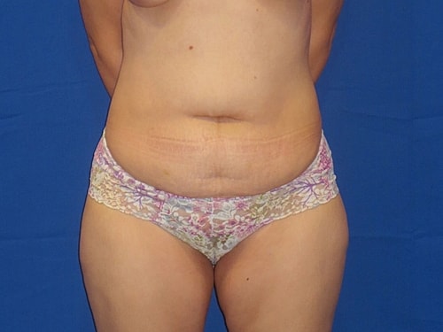 Tummy Tuck Before & After