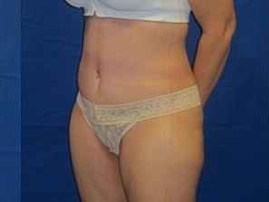 Tummy Tuck Before & After