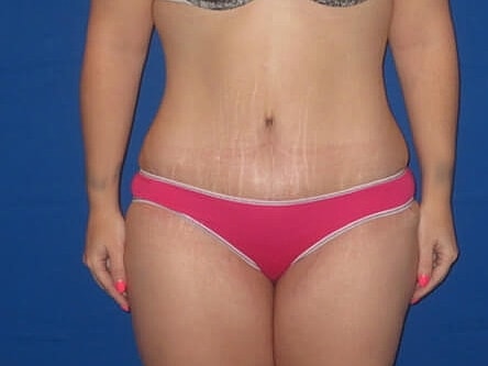 Tummy Tuck Before & After