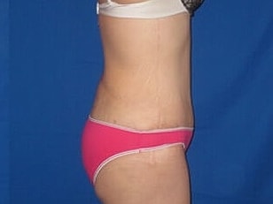 Tummy Tuck Before & After